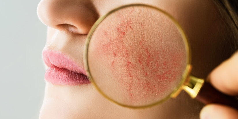 Examining face skin with rosacea problemsn