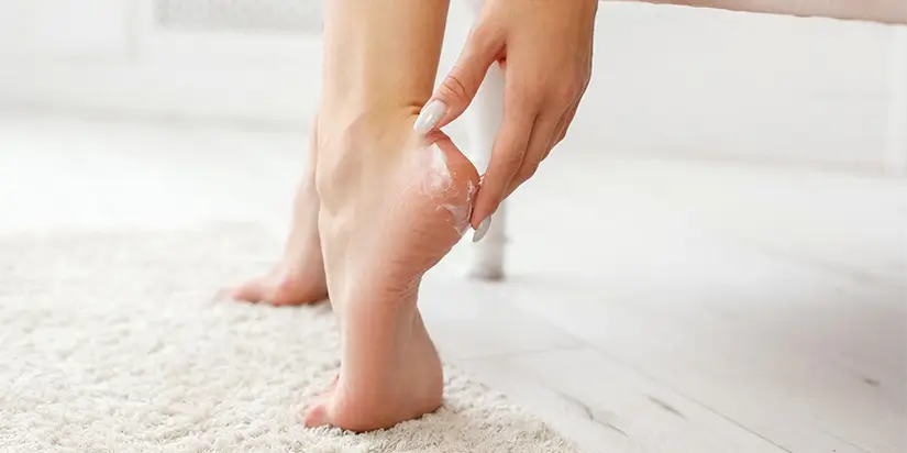 cracked heels cracked heels