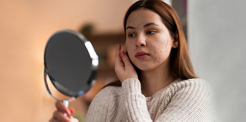 Breakouts Worse in Summer