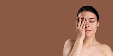 Why Your Skin Breaks Out in Hot Weather (and How to Fix It Fast)