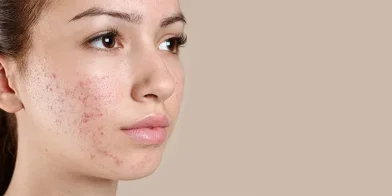 Struggling with Acne? Simple Daily Routines That Help Calm the Skin